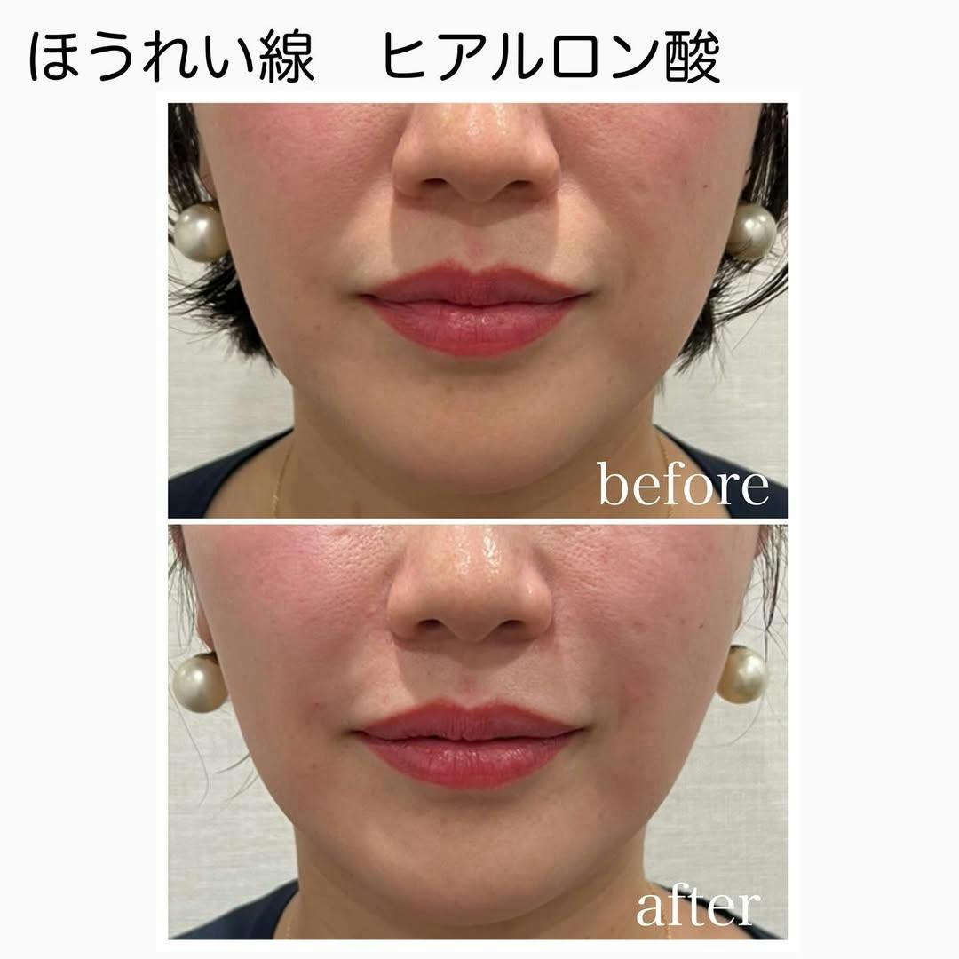 【女性・ほうれい線】ヒアルロン酸_before_aftar