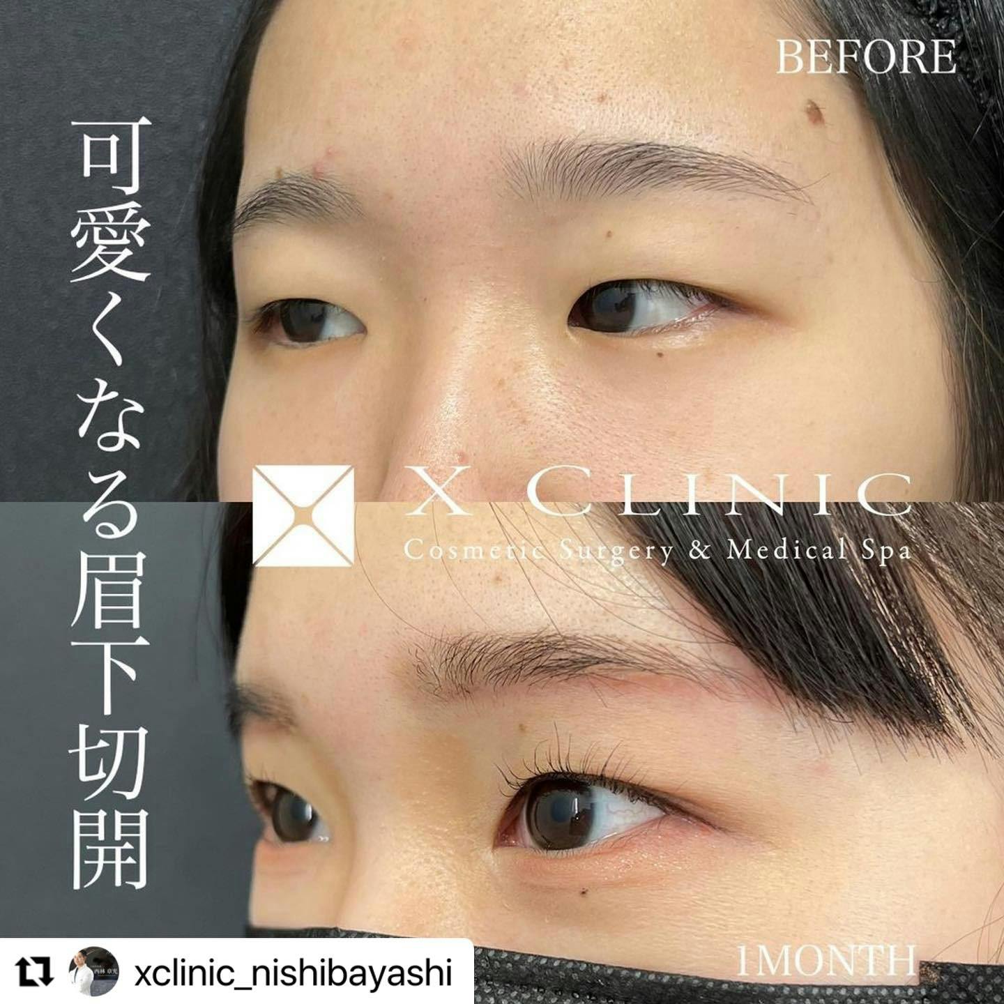 【女性・目元】眉下切開（眉下リフト）＋ROOF切除_before_aftar