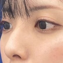 【女性・クマ】目の下の切らないクマ・たるみ(ふくらみ)取り ナチュラル脂肪注射コンデンスリッチ_after