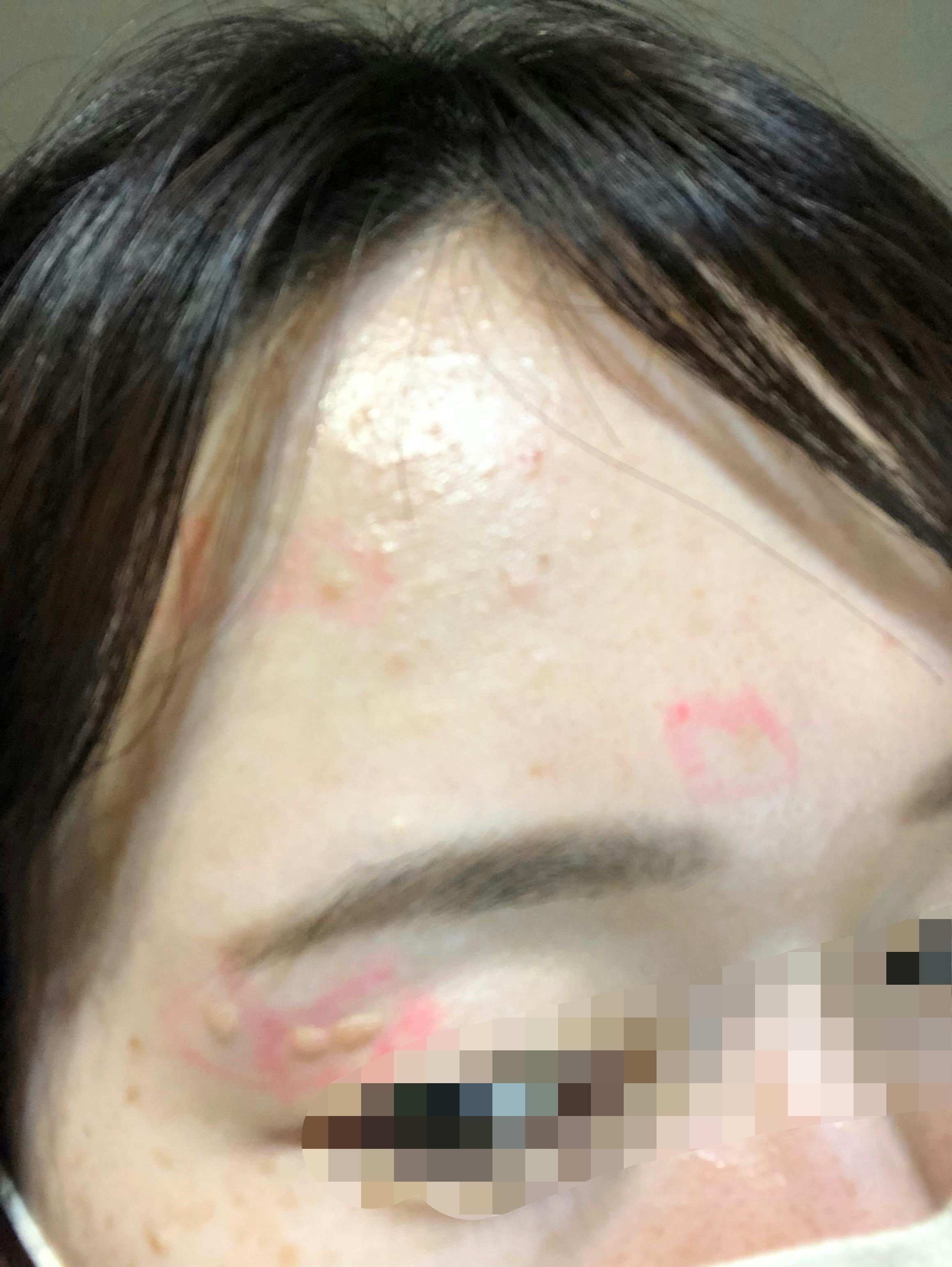 フェアクリニック川口(FAIR CLINIC)でを受けたまりもさんの写真