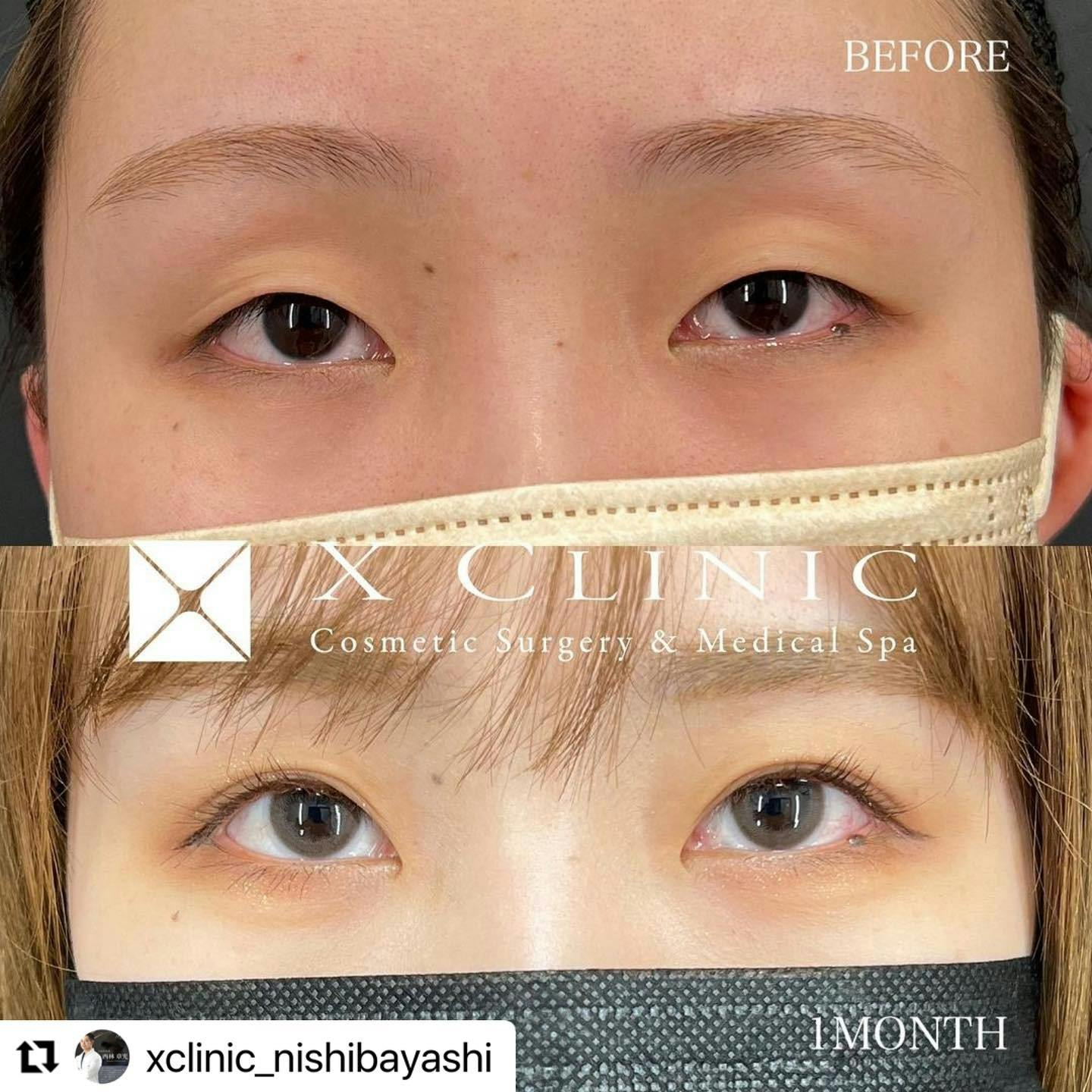 【女性・目元】エックスクロスダブル（二重埋没法）_before_aftar