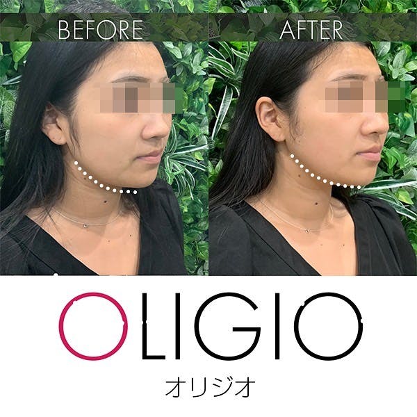 【女性・たるみ】リフトアップ(オリジオ)_before_aftar