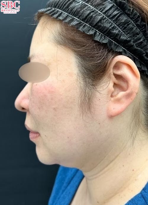 【40代女性・輪郭】美ボディ脂肪吸引_before