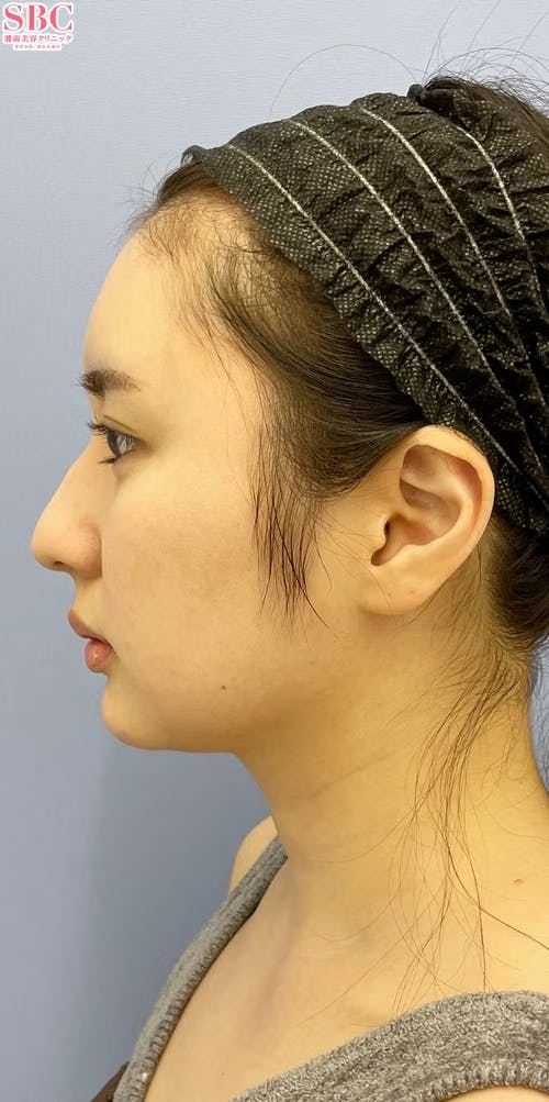 【女性・輪郭】Aquicell（アキーセル）脂肪吸引_before