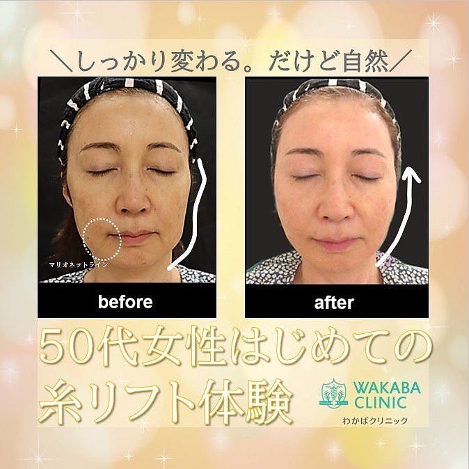 【50代女性・たるみ】糸リフト_before_aftar