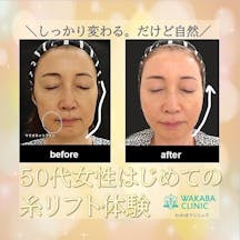 【50代女性・たるみ】糸リフト_before_aftar