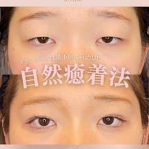 【女性・目元】自然癒着法_before_aftar