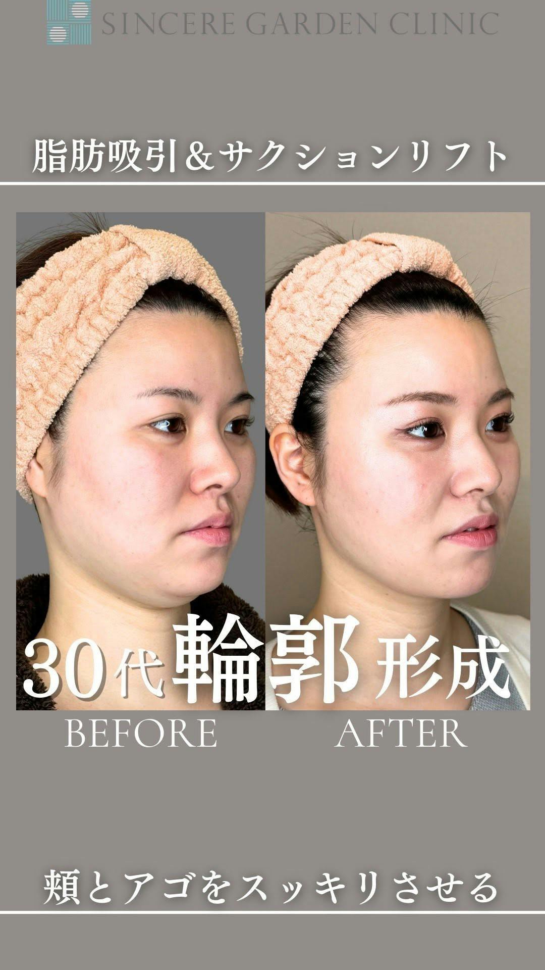 【30代女性・顎】脂肪吸引＆サクションリフト_before_aftar
