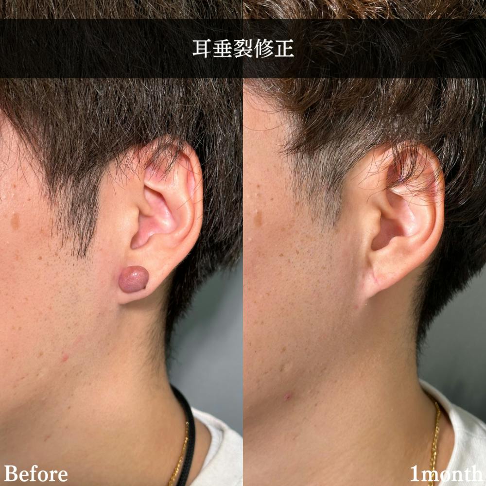 【20代男性・耳】耳垂裂修正_before_aftar