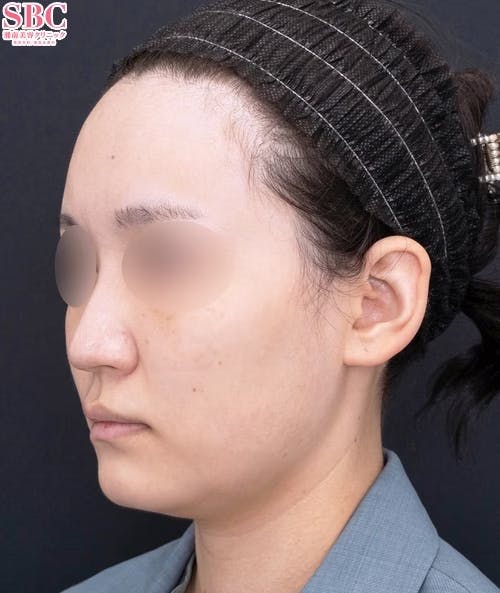 【20代女性・顔】Aquicell（アキーセル）脂肪吸引、根こそぎVASER脂肪吸引、ボトックス、SBCプリマリフト_before