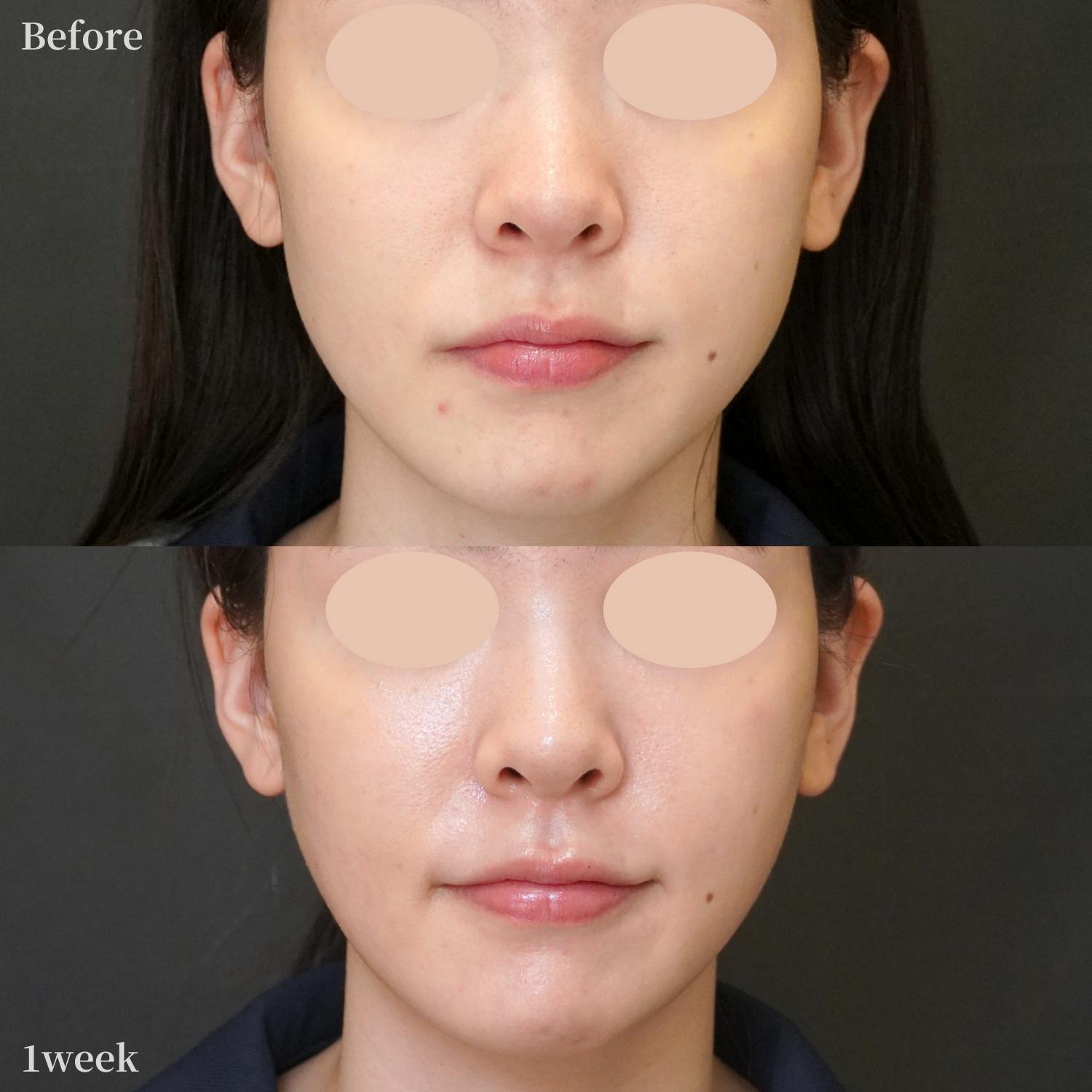 オリジオkiss_before_after