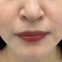 【40代女性・たるみ】VOV(ボブ)リフト・シークレットリフト_after