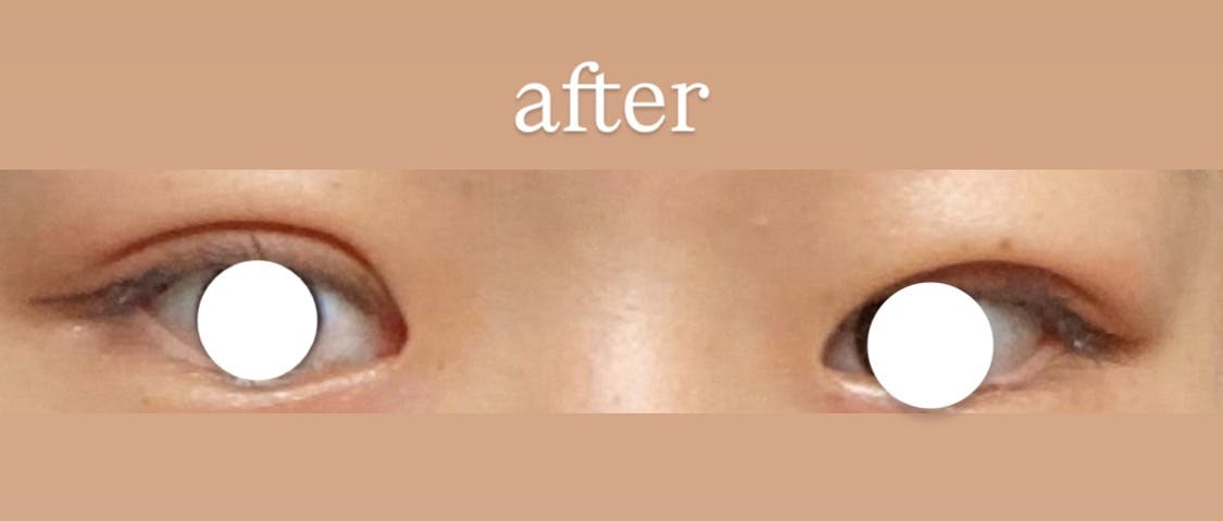 大塚美容形成外科 京都院で二重整形を受けたれさんの写真