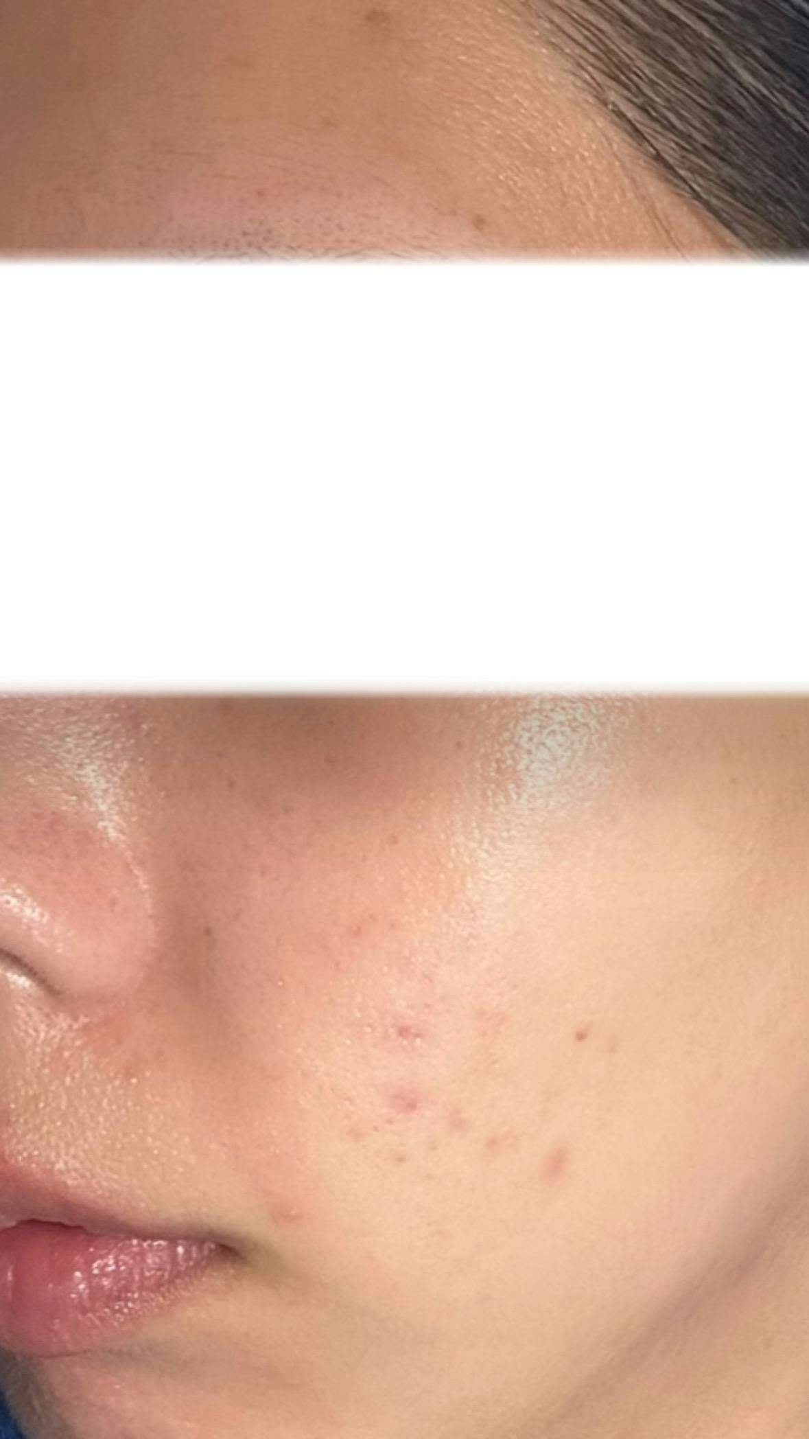 神戸ゆりクリニックでダーマペン4を受けたnurseさんの写真