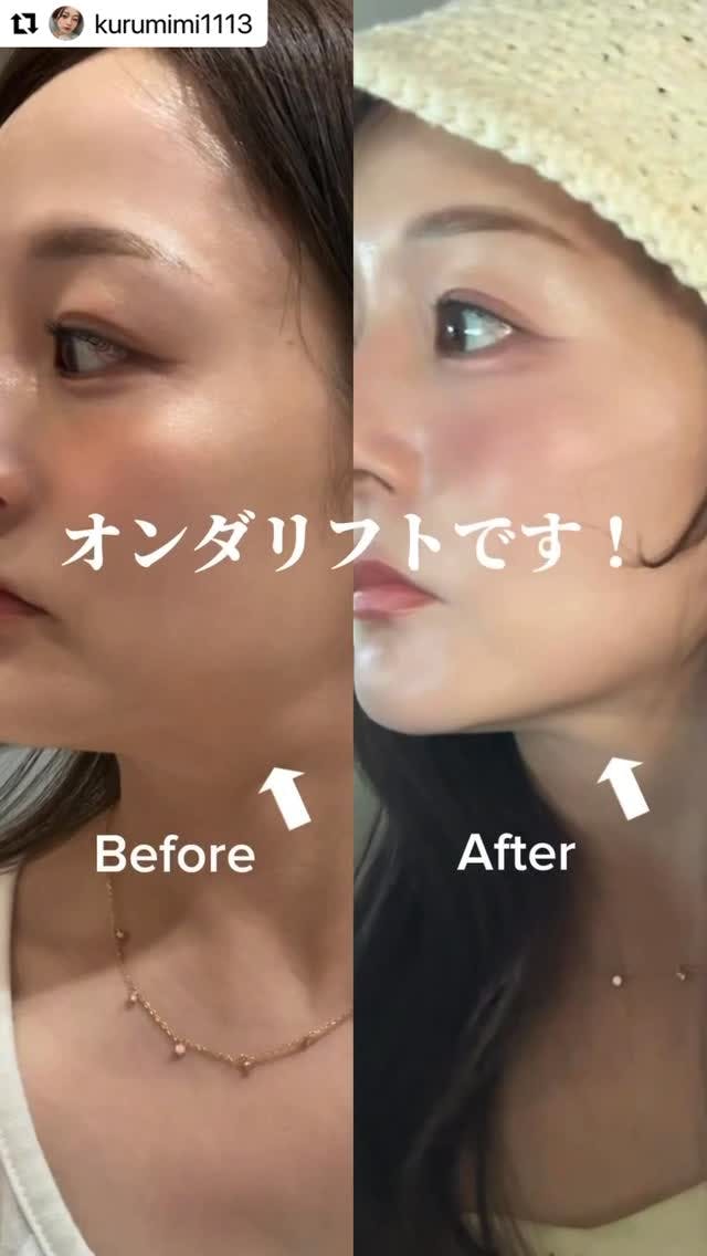 【女性・たるみ】オンダプロ_before_aftar