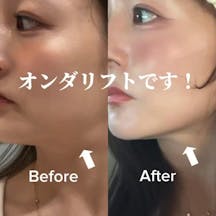 【女性・たるみ】オンダプロ_before_aftar