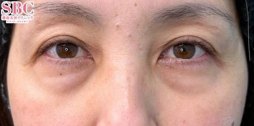 【40代女性・クマ】目の下の切らないクマ・たるみ（ふくらみ）取り、ナチュラル脂肪注射ナノリッチ、ナチュラル脂肪注射コンデンスリッチ_before