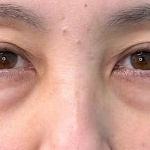 【40代女性・クマ】目の下の切らないクマ・たるみ(ふくらみ)取り、ナチュラル脂肪注射ナノリッチ、ナチュラル脂肪注射コンデンスリッチ_before