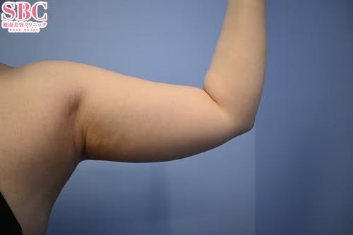 【32歳女性・二の腕】根こそぎVASER脂肪吸引、ライポマティック脂肪吸引、Aquicell（アキーセル）脂肪吸引_before
