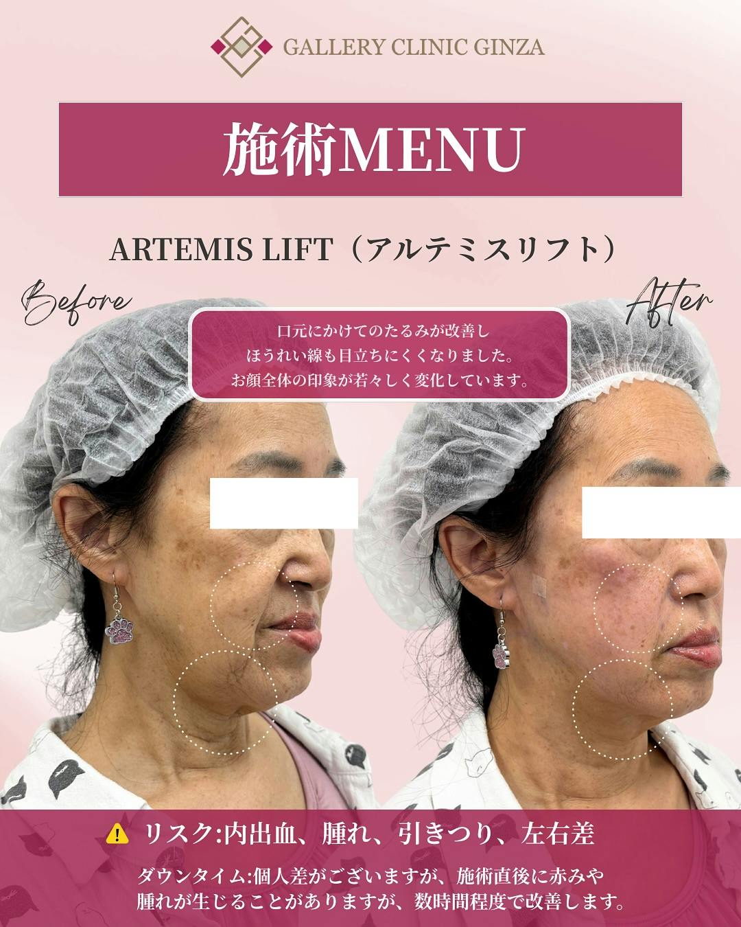 【女性・たるみ】アルテミスリフト_before_aftar