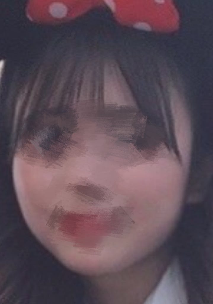 ワムクリニック銀座(WOM CLINIC GINZA)で頬顎下脂肪吸引を受けたすてらさんの写真