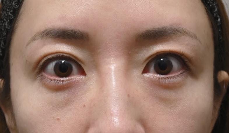 湘南美容クリニック 品川院でクマ取り：目の下の切らないクマ取り・たるみ（ふくらみ）取りを受けたぽんさんの写真
