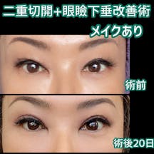 【女性・目元】二重切開+眼瞼下垂改善術_before_aftar
