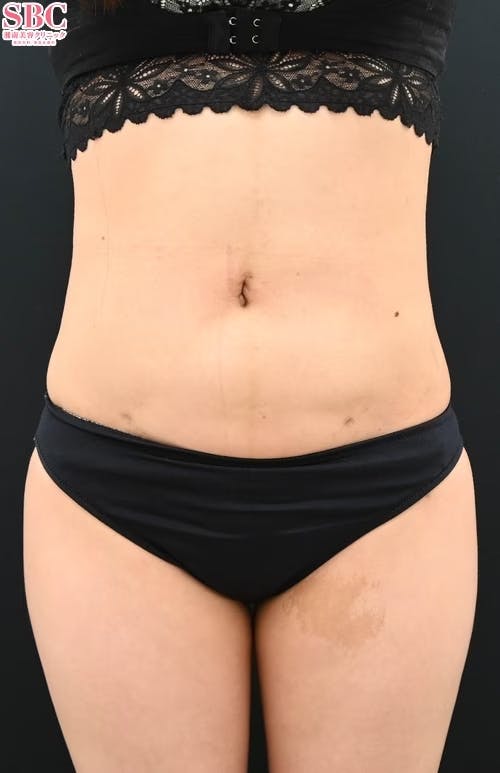 【女性・腹部】ライポマティック脂肪吸引_aftar
