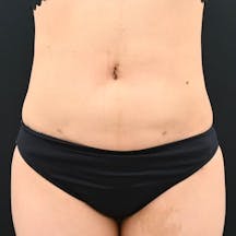 【女性・腹部】ライポマティック脂肪吸引_aftar