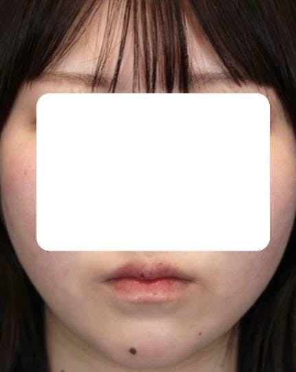 銀座よしえクリニック銀座院で二重アゴ、顎下と首のたるみ治療：脂肪溶解注射を受けた七七さんの写真