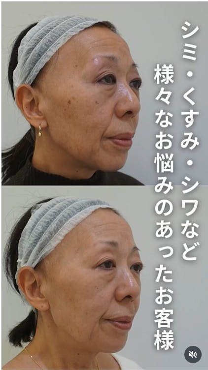 【60代女性・肌】ケミカルピーリング ジェネシス ピコトーニング ピコフラクショナル ピコスポット_before_aftar