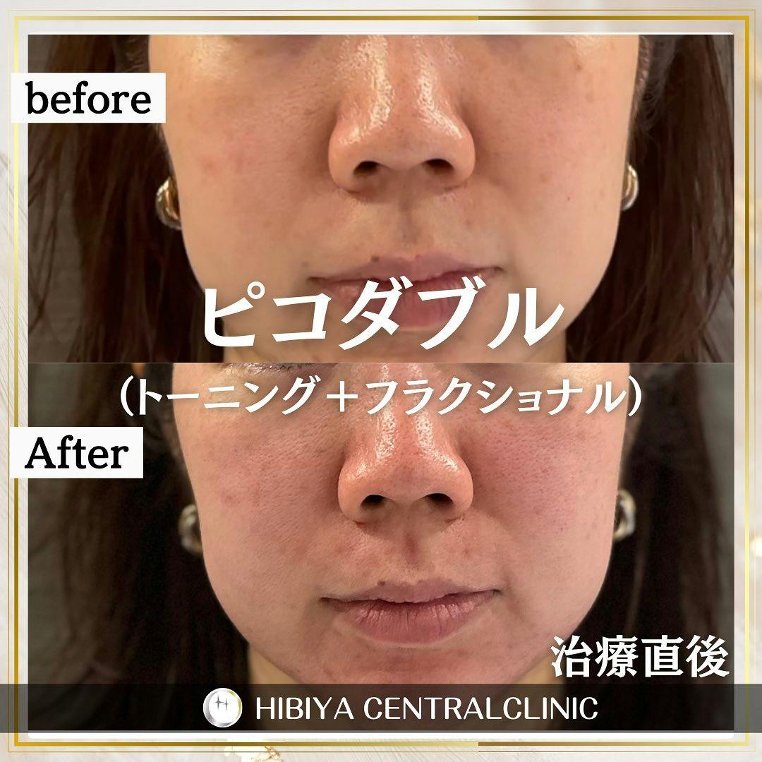 【女性・肌】ピコトーニング・ピコフラクショナル_before_aftar