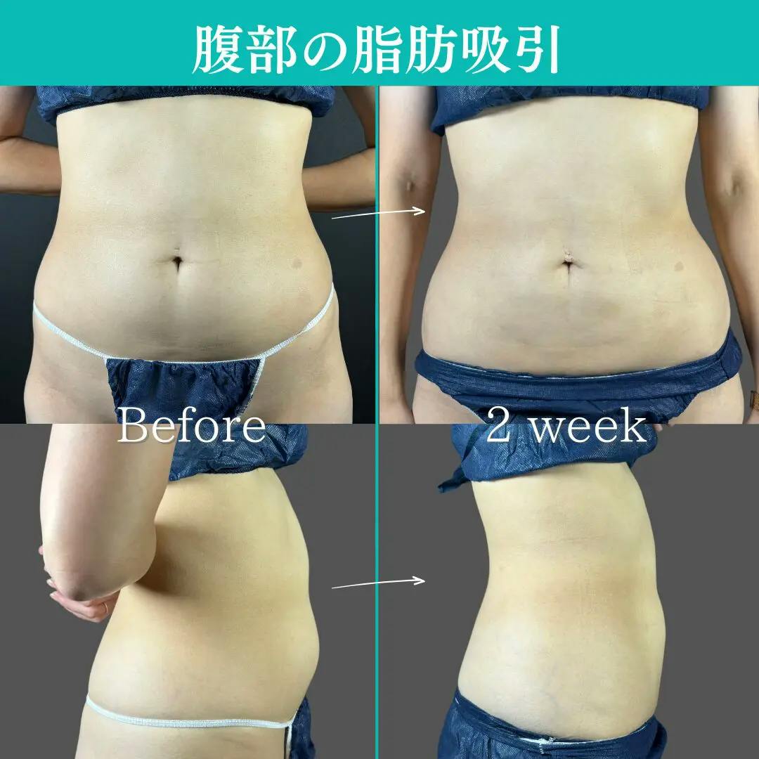 【30代女性・腹部】腹部脂肪吸引_before_aftar