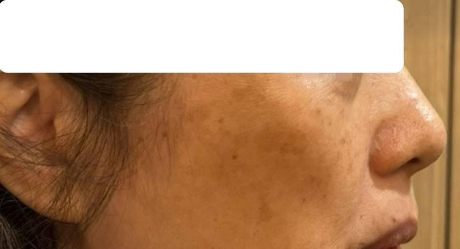 よつば会クリニック 大阪梅田院でシミ取り:シミ取り放題、リンデロン処方を受けたまゆ子さんの写真