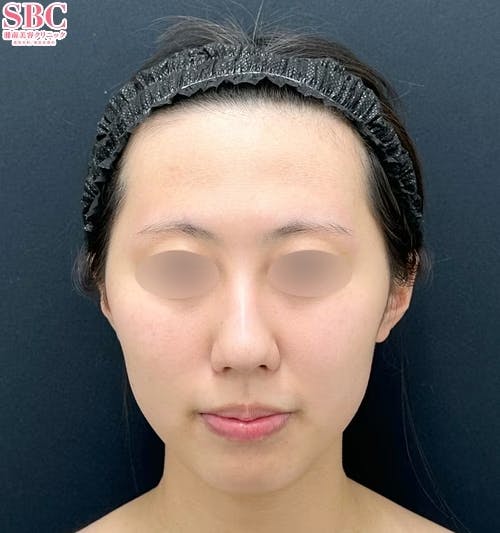 【10代女性・顔・頬・顎】Aquicell(アキーセル)脂肪吸引・ジョールファット除去術・糸リフト_before