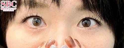 【女性・目元】目の下の切らないクマ・たるみ（ふくらみ）取り_aftar