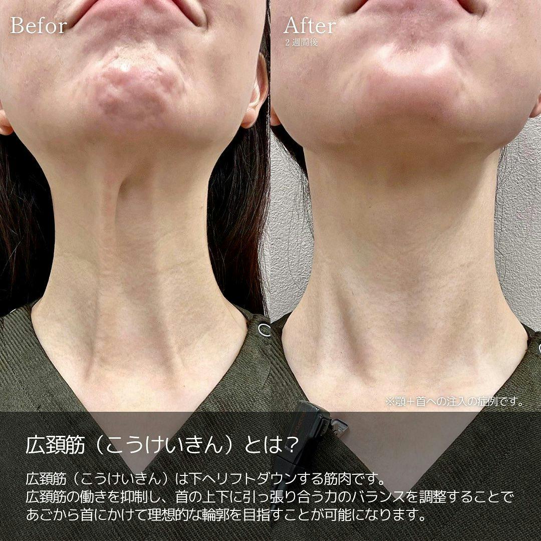 【女性・たるみ】首ボツリヌストキシン注射_before_aftar
