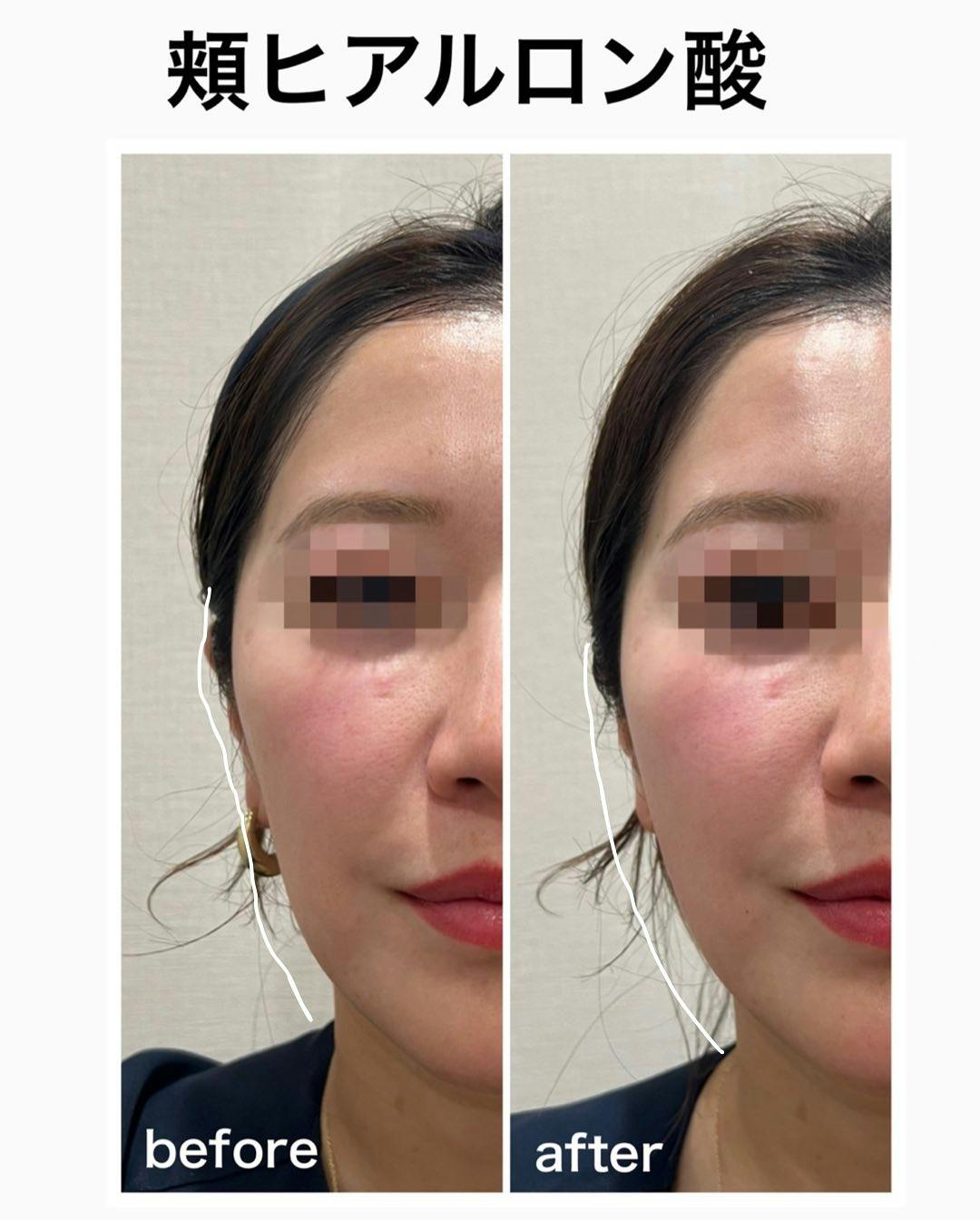【女性・顎】ヒアルロン酸_before_aftar