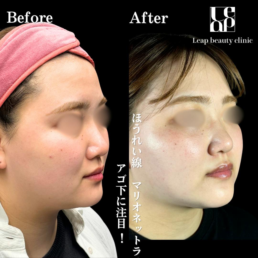 【20代女性・輪郭】頬・顎下脂肪吸引・TESSリフト_before_aftar