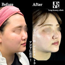 【20代女性・輪郭】頬・顎下脂肪吸引・TESSリフト_before_aftar