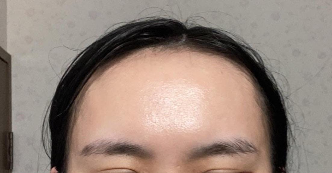 ヴェリテクリニック 銀座院で額形成：額ヒアルロン酸を受けたれぃさんの写真