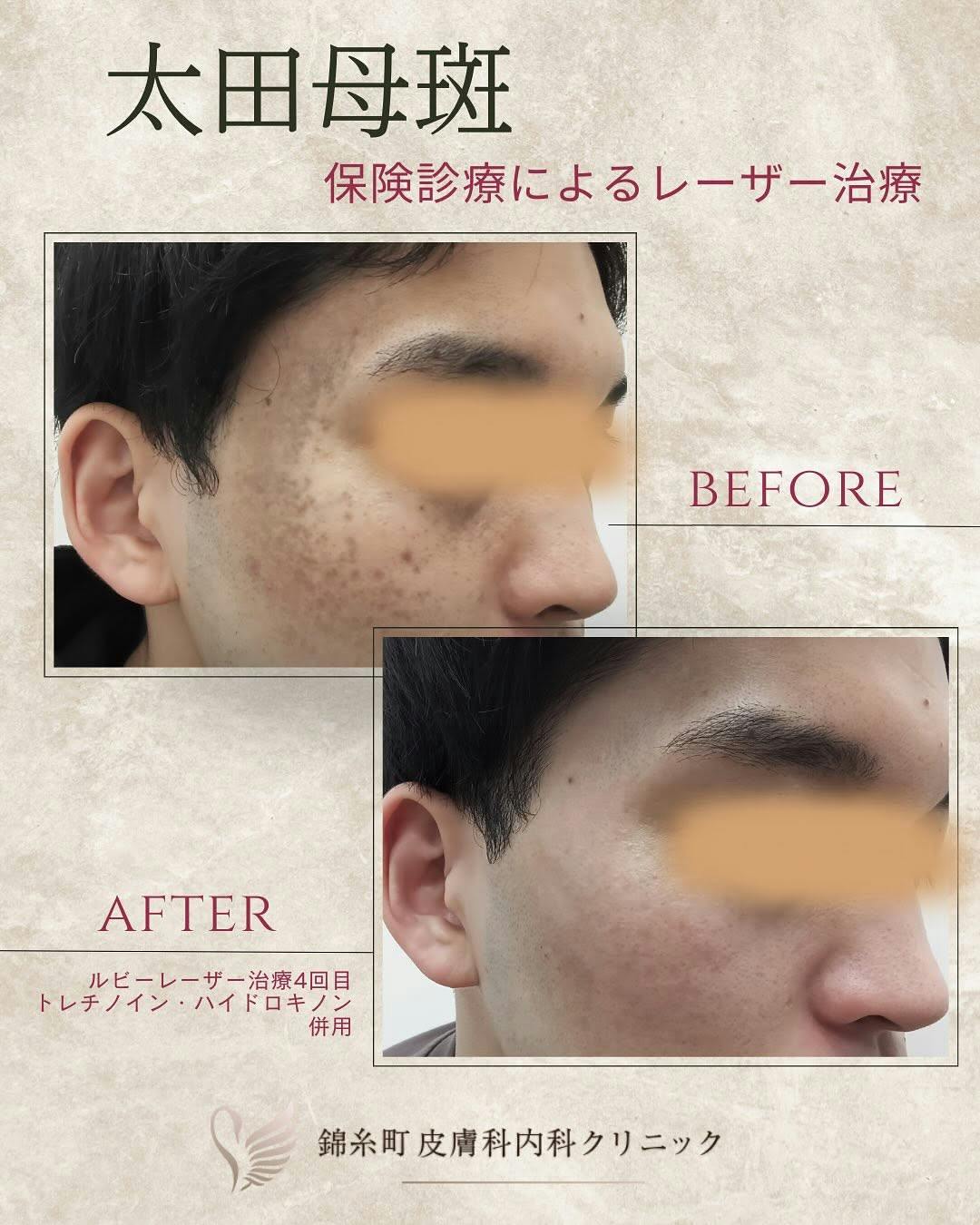 【男性・太田母斑】ルビーレーザー治療_before_aftar