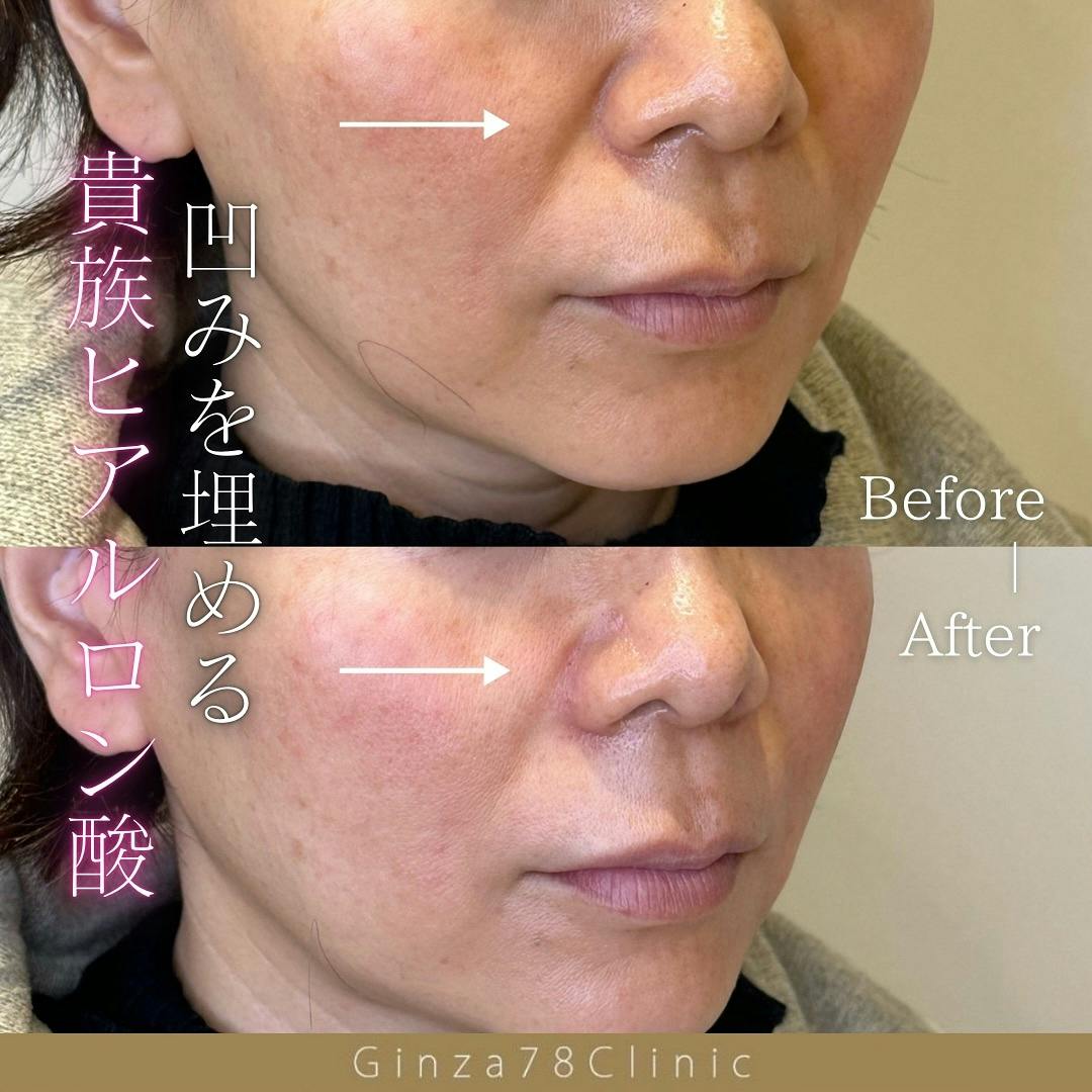 【女性・ほうれい線】ヒアルロン酸_before_aftar