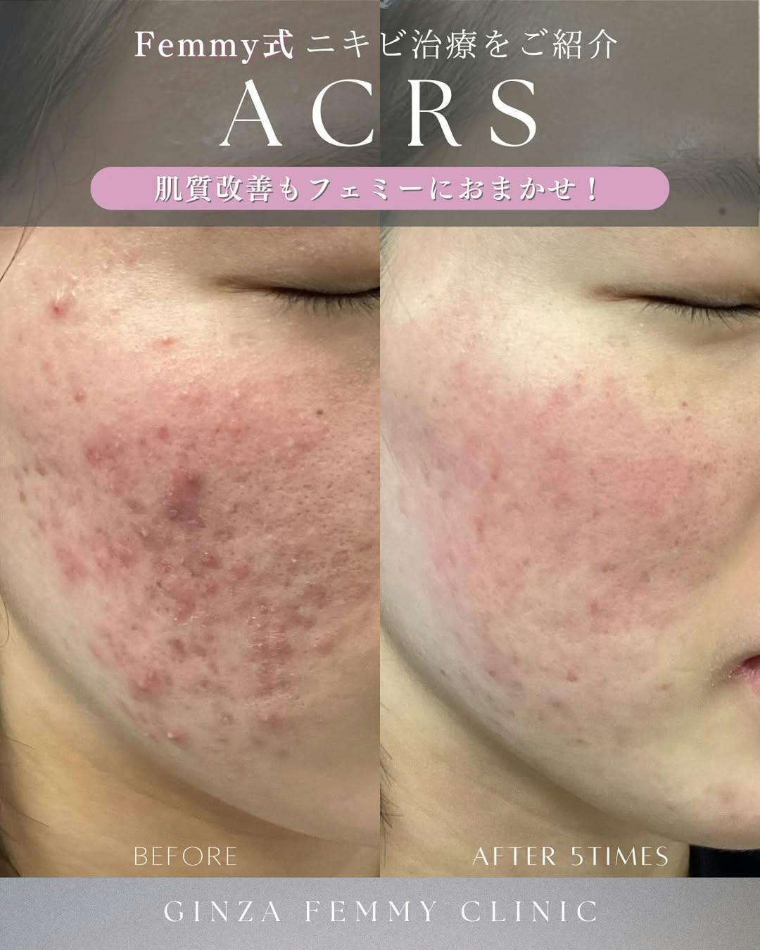 【女性・赤み】ACRS_before_aftar