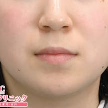 【女性・輪郭】顔の脂肪吸引_before