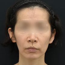 【女性・輪郭】VOV(ボブ)リフト、シークレットリフト、小顔若返りリフト_before