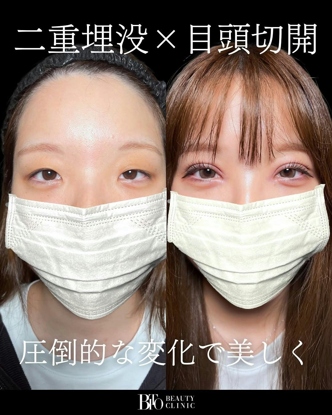 【女性・目元】二重整形・目頭切開_before_aftar