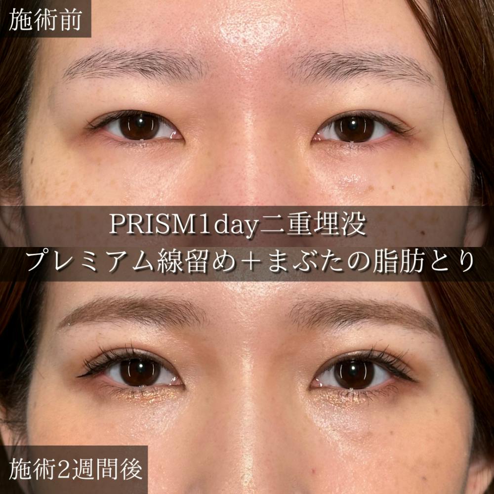 【20代女性・目】PRISM 1day二重埋没+まぶたの脂肪取り(自然癒着法)_before_aftar