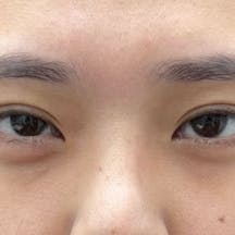 【女性・目元】目の下の切らないクマ・たるみ(ふくらみ)取り、ナチュラル脂肪注射コンデンスリッチ_before