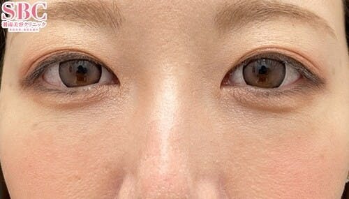 【30代女性・目元】裏ハムラ法 ナチュラル脂肪注射ナノリッチ VOV（ボブ）リフト_1month